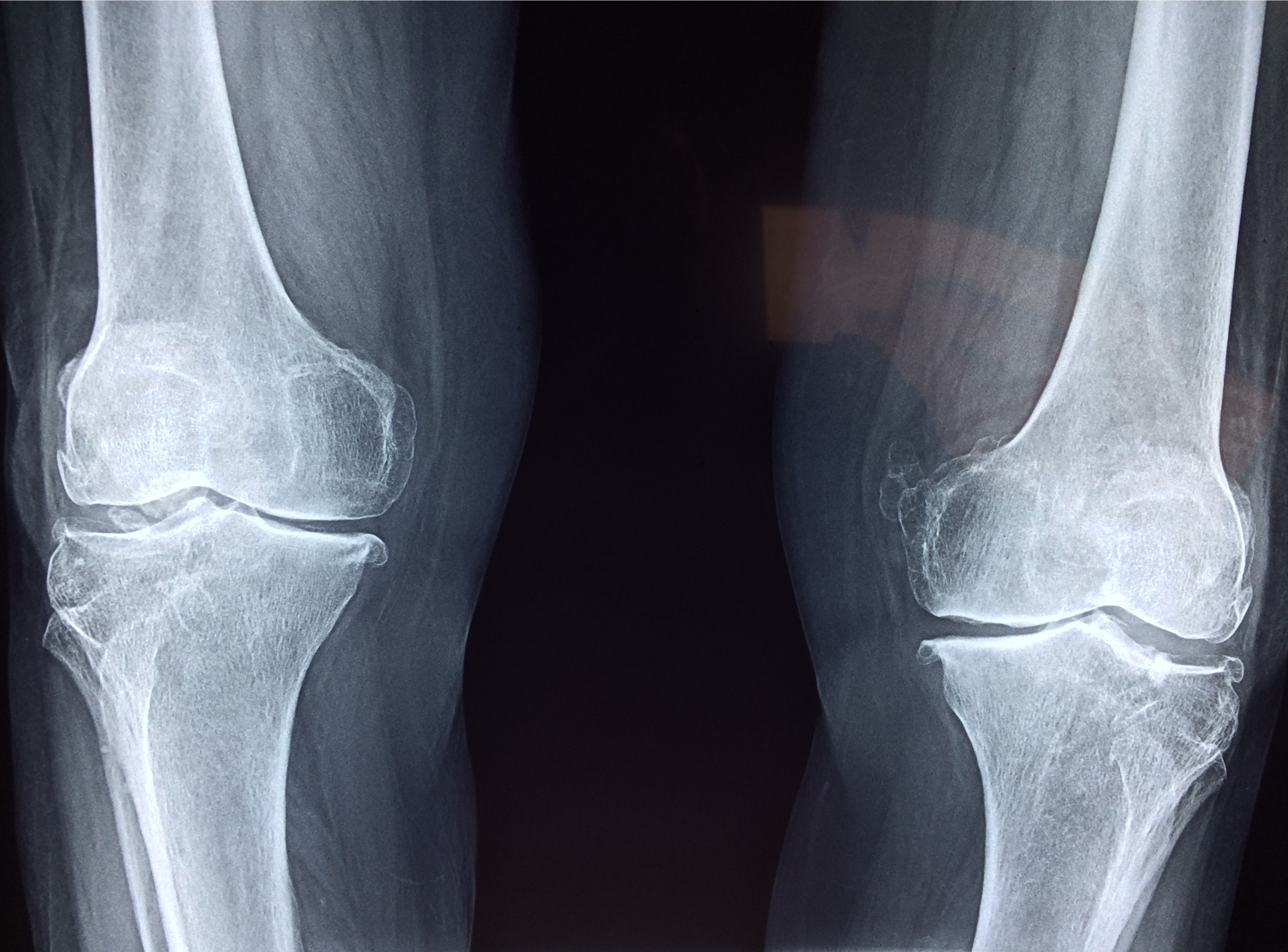 Arthrose du genou - Illustration médicale
